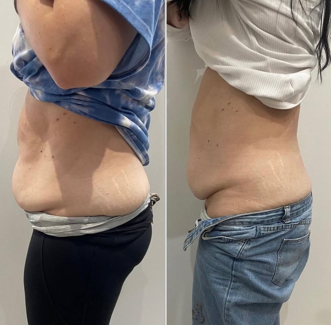 Before and After 1