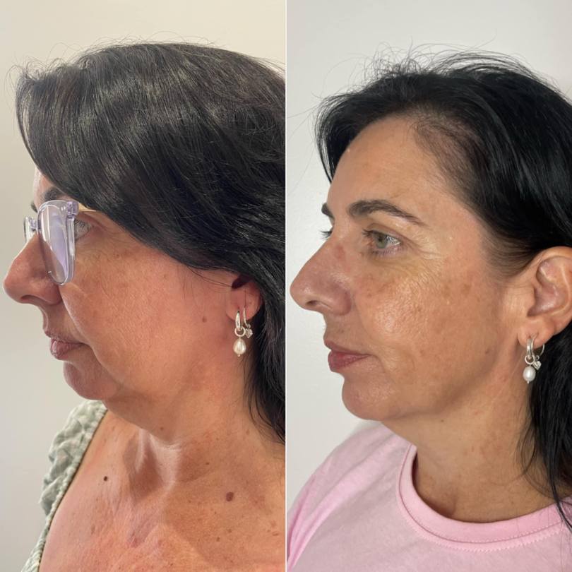 Before After 1