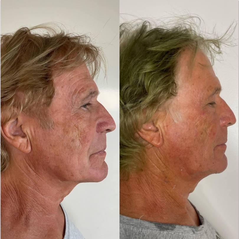 Before After 2