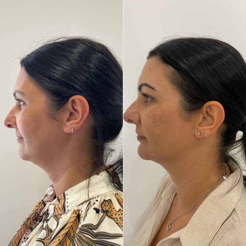 Before After 3