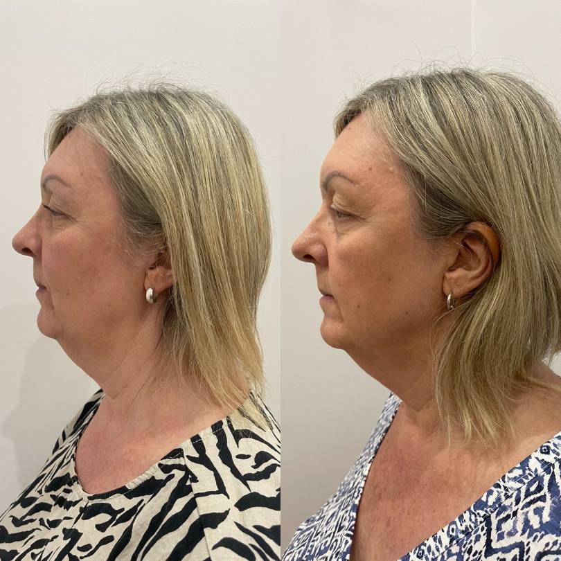 Before After 4