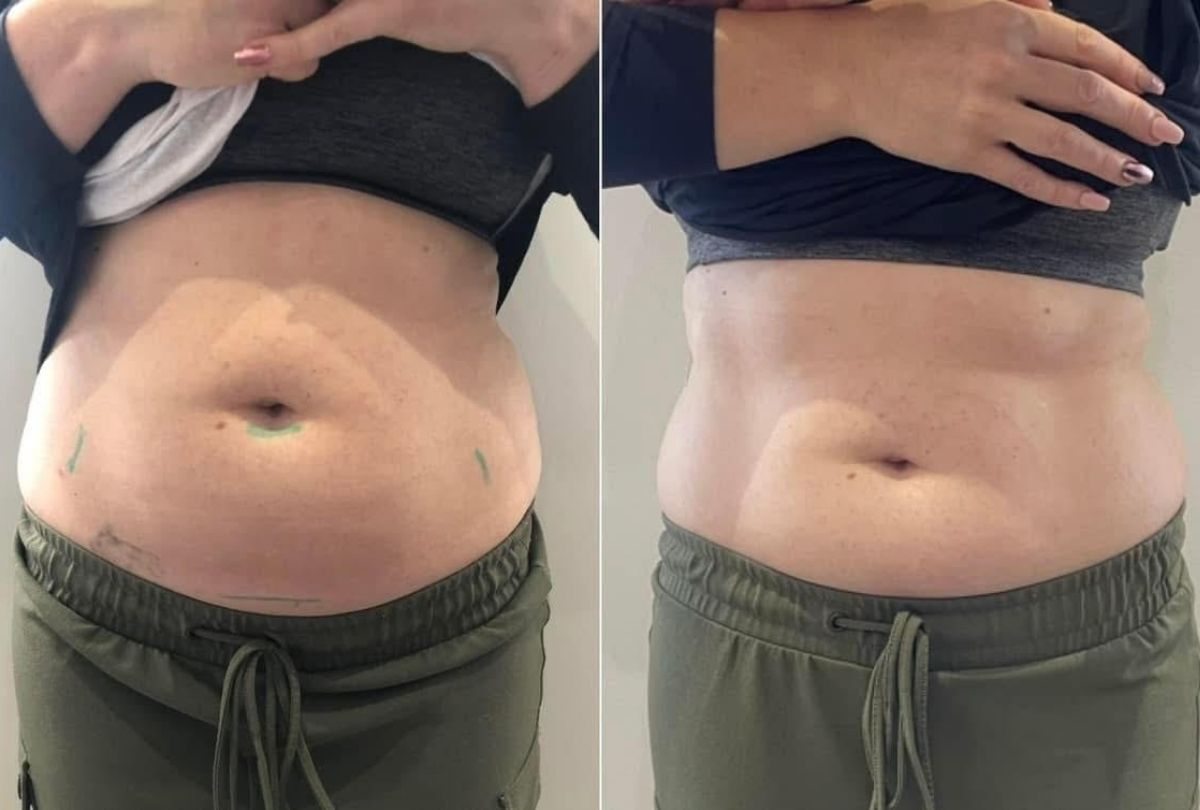 Before After 1