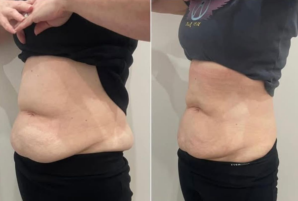Before After 2