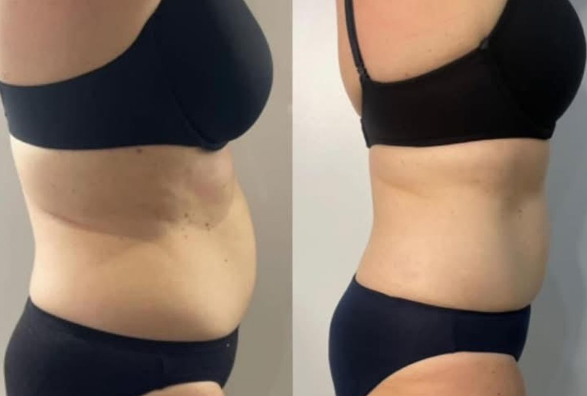 Before After 4