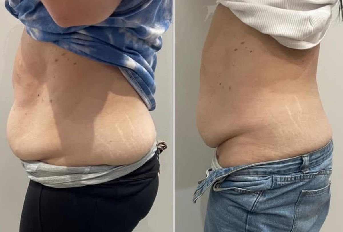 Before After 5