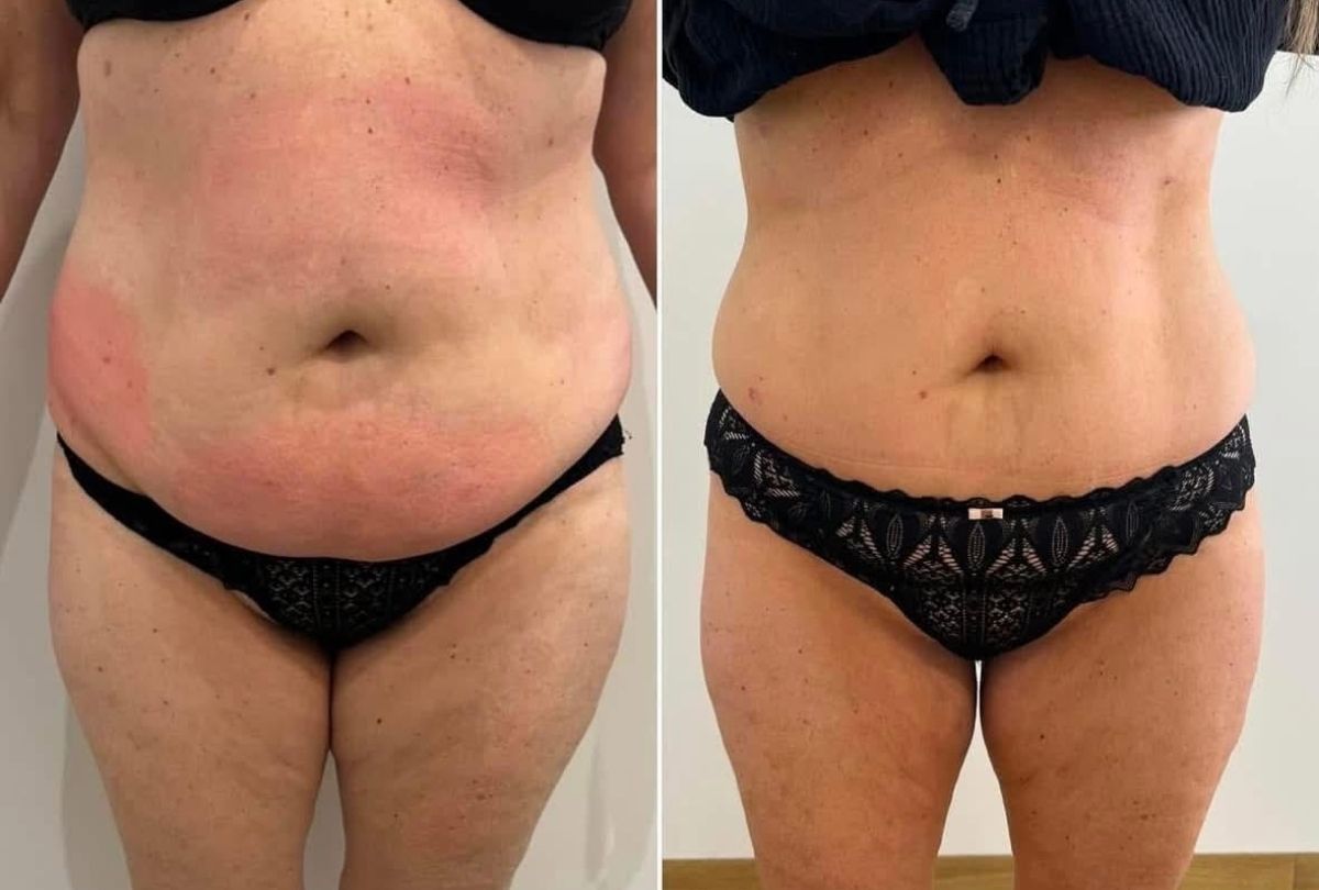 Before After 6