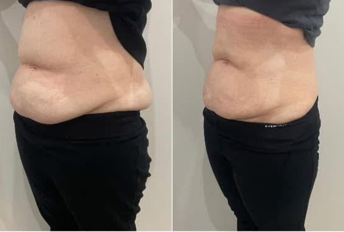 Before After 7