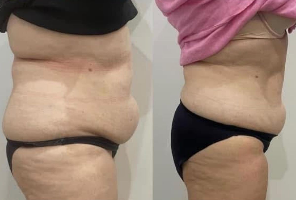 Before After 8
