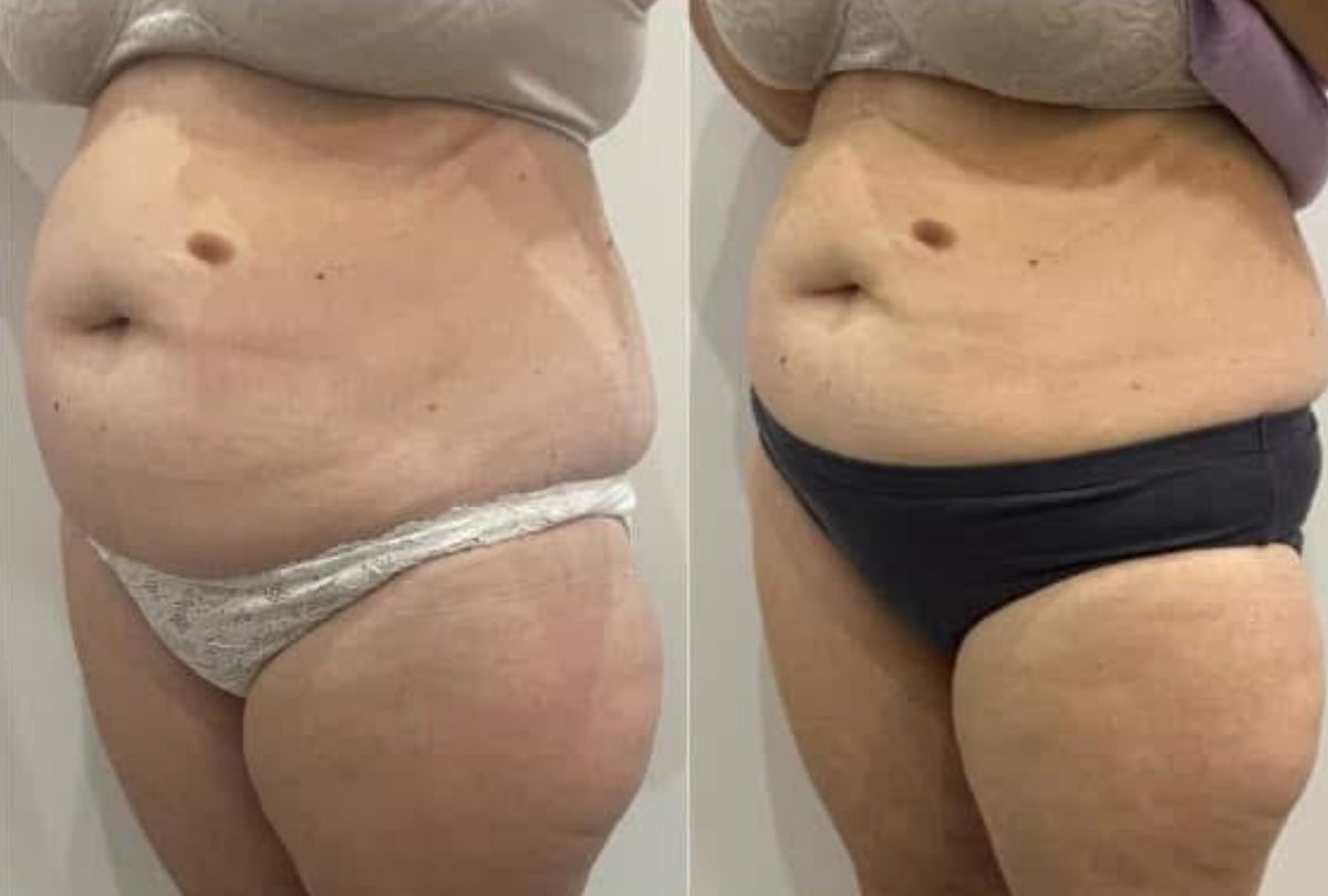 Before After 9